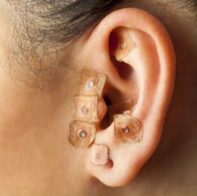 Auriculoterapia Glossário temático PICS Ministério da Saíde 1ª ed 2018