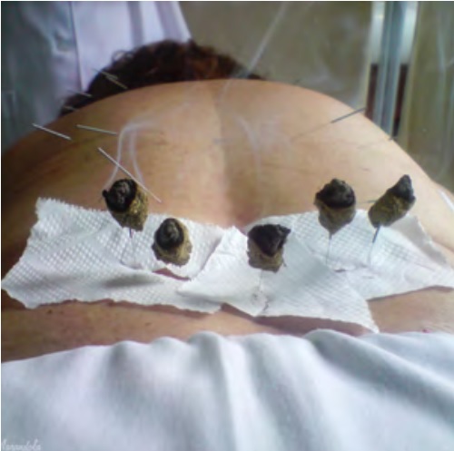 Moxabustão Glossário temático PICS Ministério da Saíde 1ª ed 2018