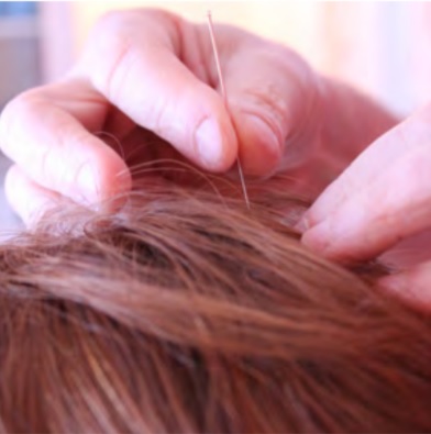 Craniopuntura Glossário temático PICS Ministério da Saíde 1ª ed 2018